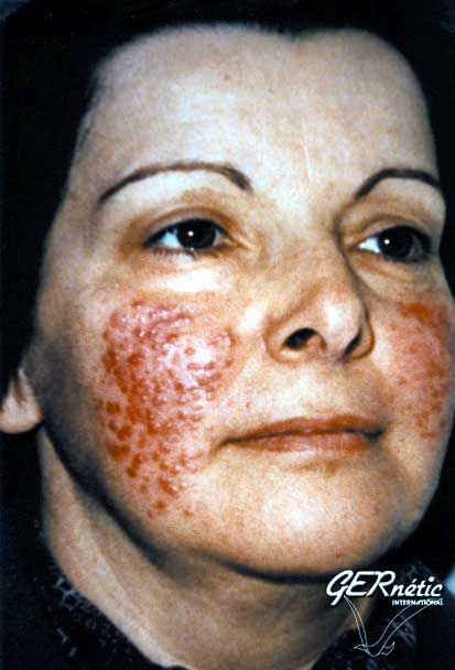 Rosaceous Acne - Before
